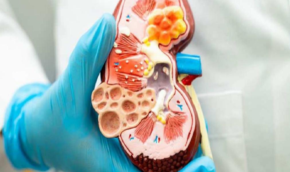 Robotik Cerrahi ile Böbrek Tümörü Tedavisinde Yeni Dönem: Parsiyel Nefrektomi ve Hızlı İyileşme