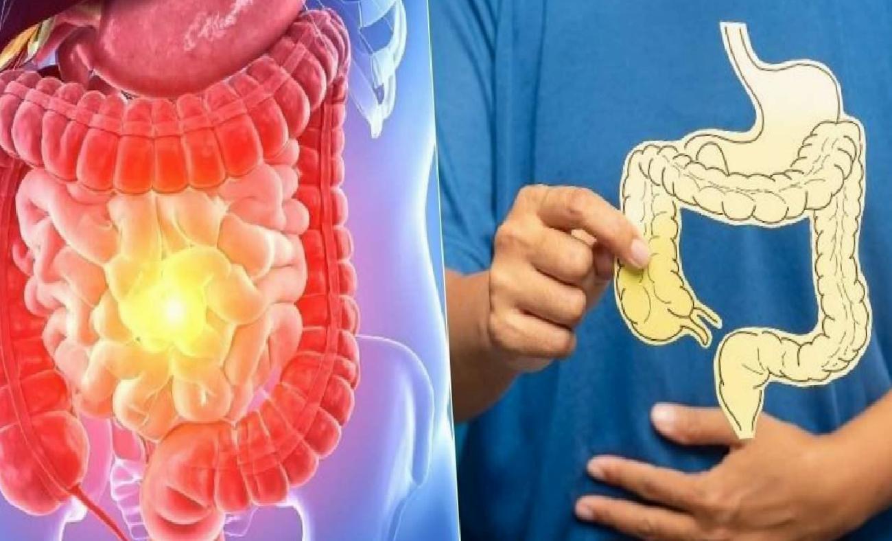 Genç Yetişkinlerde Kolon Kanseri: 42 Ülkede Geniş Analizin Bulguları ve Risk Faktörleri