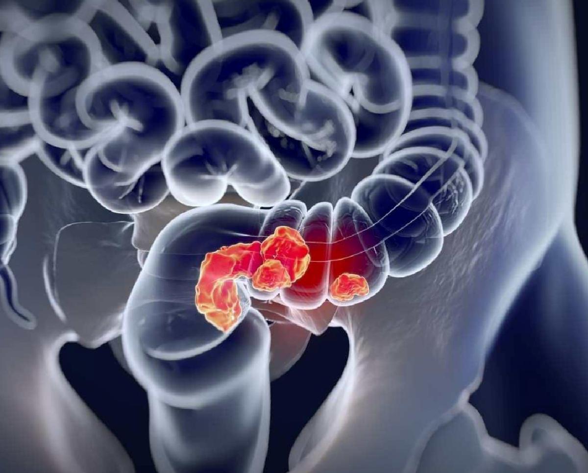 Genç Yetişkinlerde Kolon Kanseri: 42 Ülkede Geniş Analizin Bulguları ve Risk Faktörleri