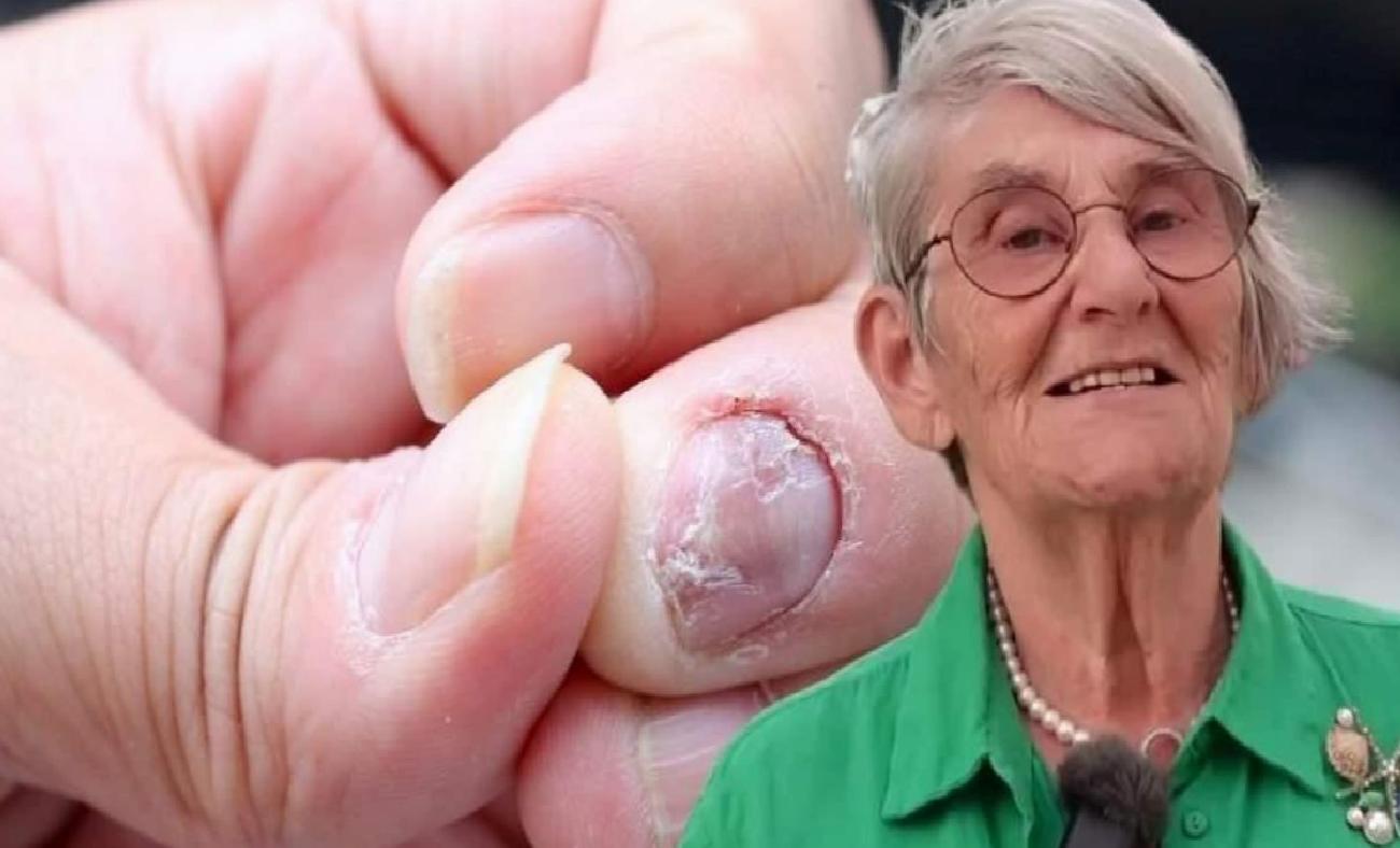 Karatay’dan Doğal Çözüm: Ayak Mantarıyla Mücadelede Şeker ve Kimyasal İçermez Yaklaşım