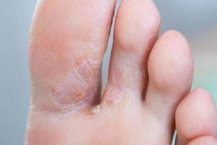 Karatay’dan Doğal Çözüm: Ayak Mantarıyla Mücadelede Şeker ve Kimyasal İçermez Yaklaşım