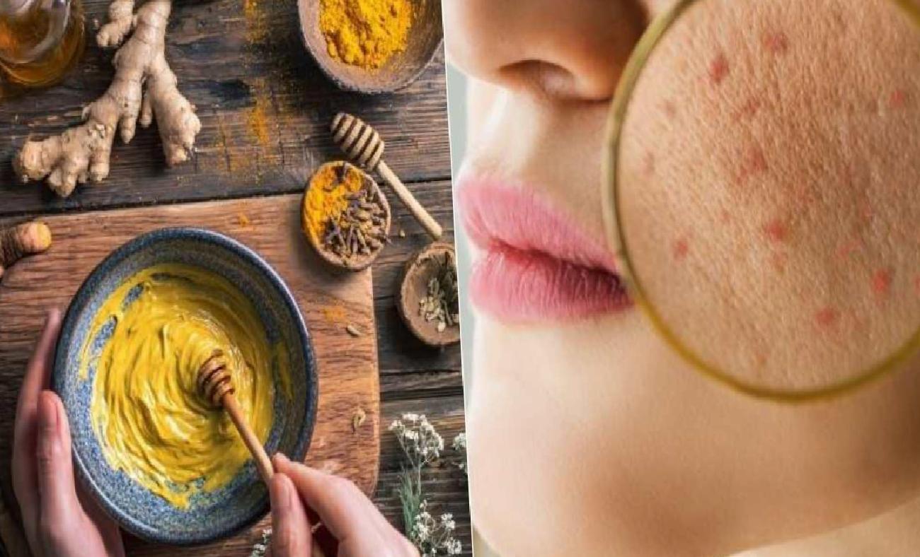 Stres ve Hormon Değişiklikleriyle Mücadelede Doğal Akne Maskesi: Zerdeçal ve Bal