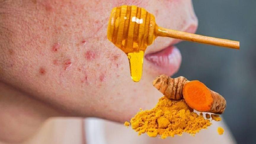 Stres ve Hormon Değişiklikleriyle Mücadelede Doğal Akne Maskesi: Zerdeçal ve Bal