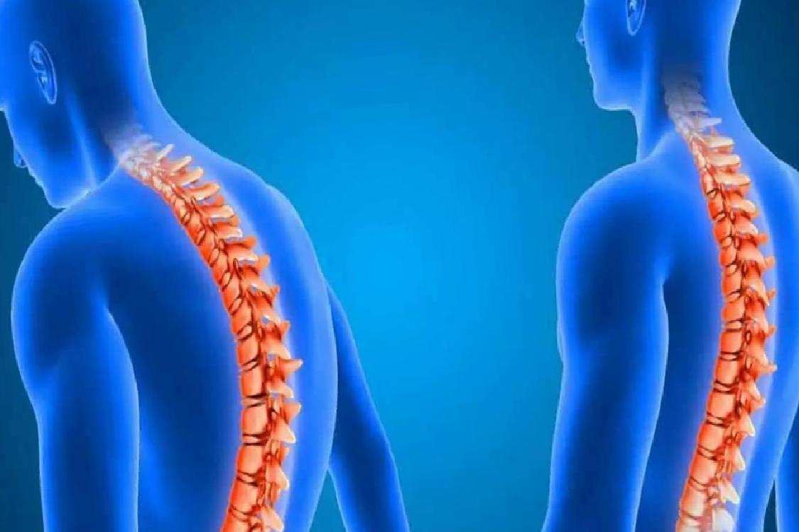 Ankilozan Spondilit: Gençlerde Bel ağrısının Ardındaki Gizli Tehdit ve Erken Tedavi Önemi