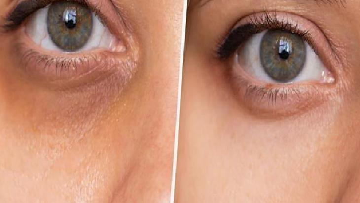 Göz Altı İçin Doğal Serum: İçerik, Kullanım ve Dikkat Edilecekler