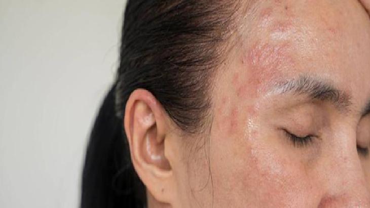 Egzama Dostu Doğal Balm Rehberi: İçerikler, Uygulama ve Dikkat Edilmesi Gerekenler