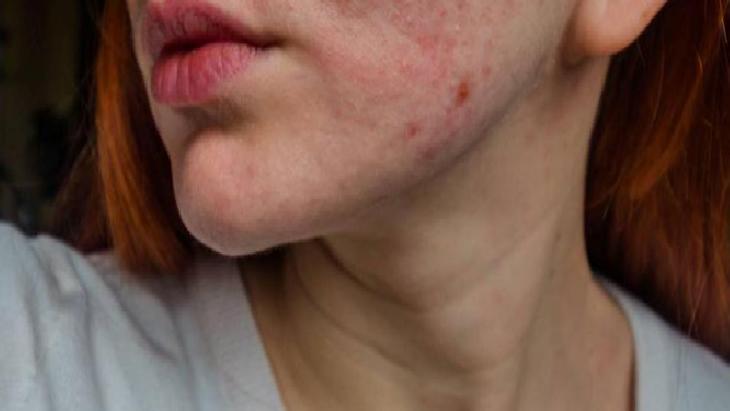 Egzama Dostu Doğal Balm Rehberi: İçerikler, Uygulama ve Dikkat Edilmesi Gerekenler