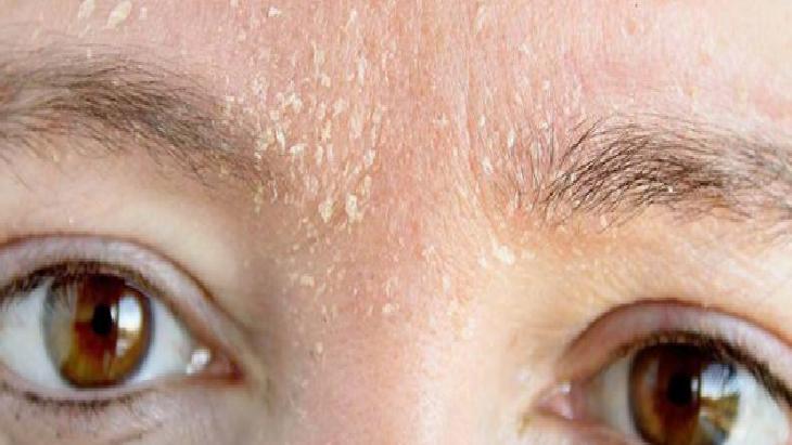 Egzama Dostu Doğal Balm Rehberi: İçerikler, Uygulama ve Dikkat Edilmesi Gerekenler