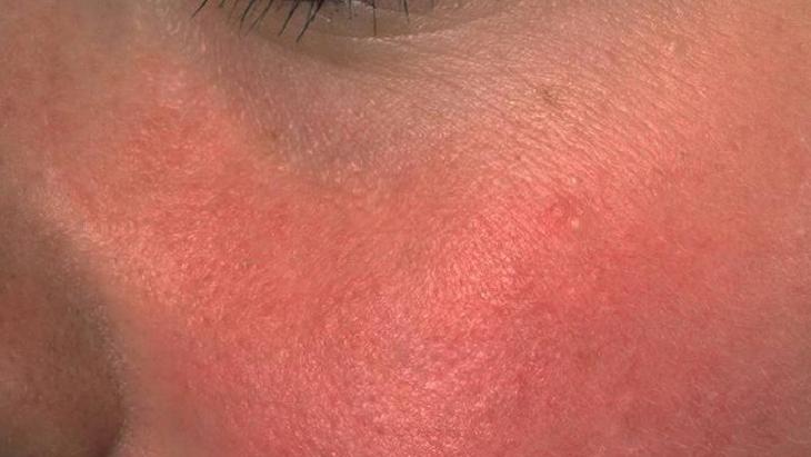 Egzama Dostu Doğal Balm Rehberi: İçerikler, Uygulama ve Dikkat Edilmesi Gerekenler