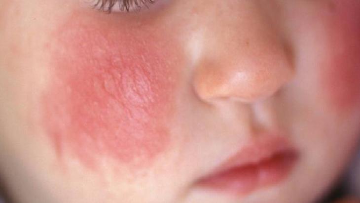 Egzama Dostu Doğal Balm Rehberi: İçerikler, Uygulama ve Dikkat Edilmesi Gerekenler