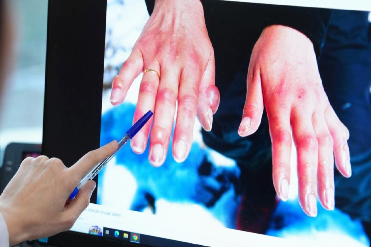 Kışın Soğuk Isırığına Karşı Erken Önlem ve Tedavi Yolu: Uzmanın Uyarıları