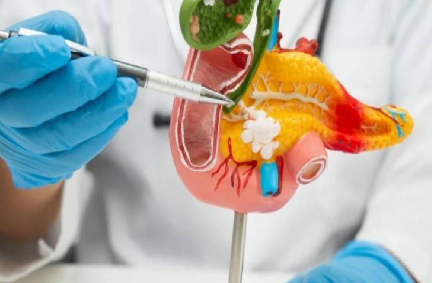 Pankreas Kanseriyle Mücadelede Erken Tanı ve Hasta Seçiminin Önemi