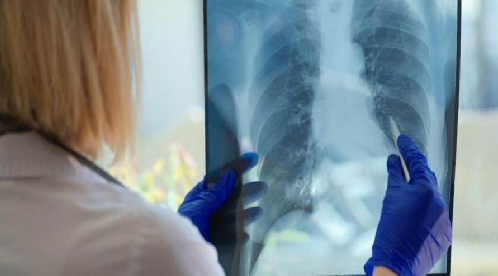 Verem ve Toplum Sağlığı: Erken Tanı ve Tedavinin Önemi