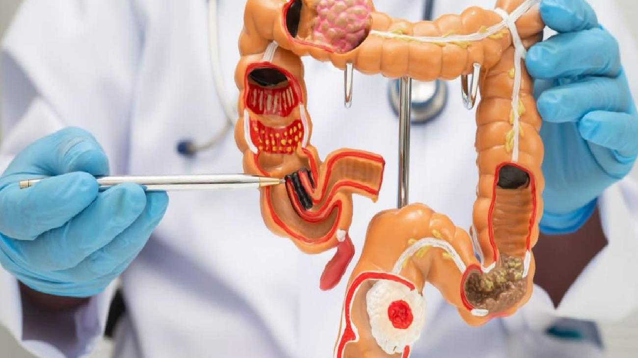 50 Yaş ve Üstünde Kolon Kanseri Tarama Rehberi: Erken Teşhis ve Tarama Noktaları