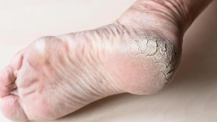 Doğal Ayak Peelingi: Şeker, Karbonat ve Zeytinyağıyla Hafif Nemli Bakım