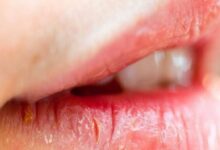 Close-up of a person's lips with cracked, peeling skin and a small yellow crust at the left corner of the mouth.