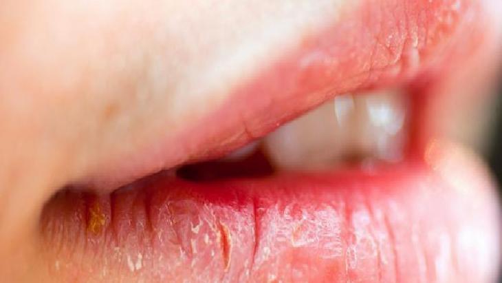 Close-up of a person's lips with cracked, peeling skin and a small yellow crust at the left corner of the mouth.