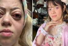 Two-panel photo: left shows a woman with red, swollen eyes and a tired expression; right shows her in a pink lace dress with a floral headband, posing with her hand under her chin.