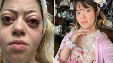 Two-panel photo: left shows a woman with red, swollen eyes and a tired expression; right shows her in a pink lace dress with a floral headband, posing with her hand under her chin.