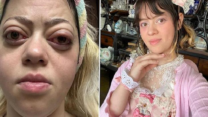 Two-panel photo: left shows a woman with red, swollen eyes and a tired expression; right shows her in a pink lace dress with a floral headband, posing with her hand under her chin.