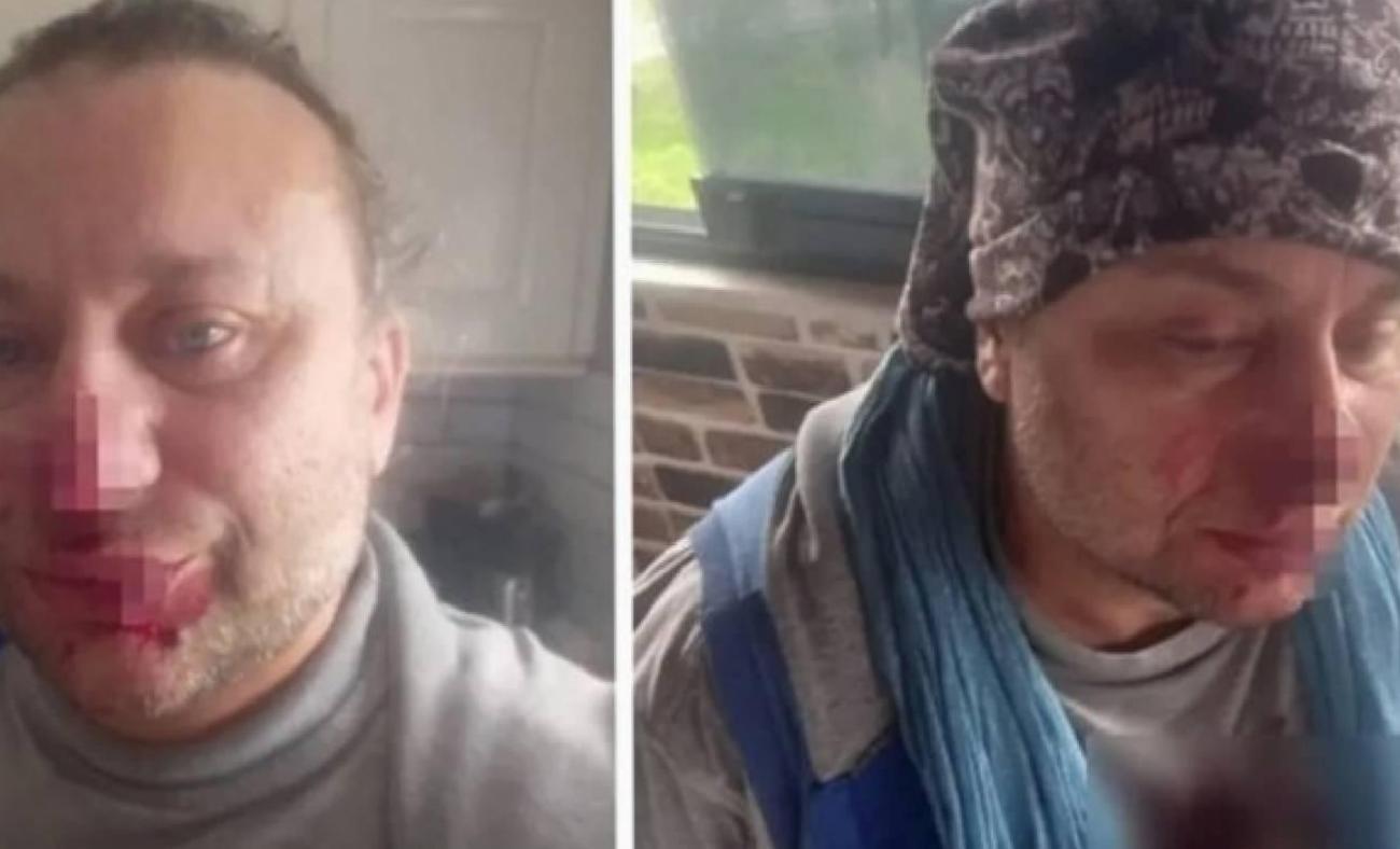 Onur Akay: Nekrotizan Fasiit sonrası yoğun bakım macerası ve yaşadığı zorluklar