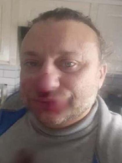 Onur Akay: Nekrotizan Fasiit sonrası yoğun bakım macerası ve yaşadığı zorluklar