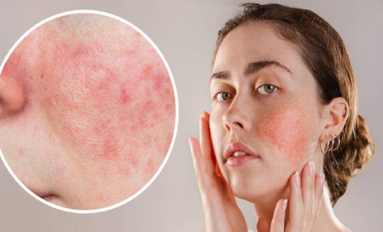 Rozasea (Gül Hastalığı): Belirti, Tetikleyiciler ve Yönetim Stratejileri