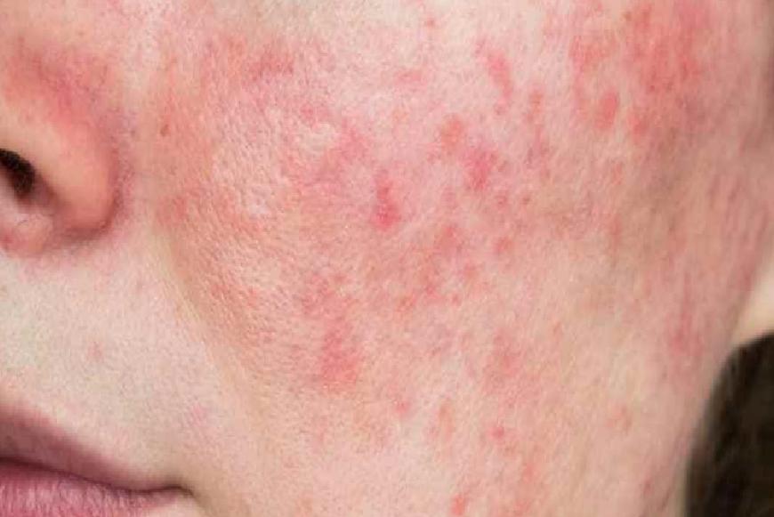 Rozasea (Gül Hastalığı): Belirti, Tetikleyiciler ve Yönetim Stratejileri