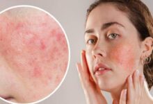 Young woman with flushed red cheeks and a close-up inset of inflamed facial skin on her cheek area.