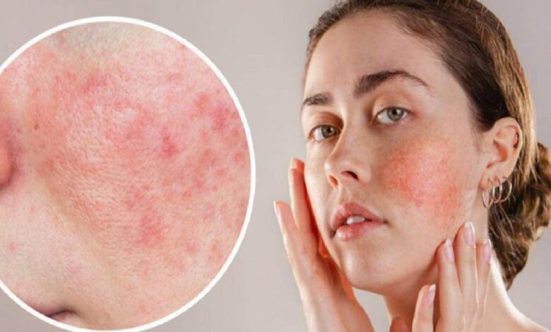 Young woman with flushed red cheeks and a close-up inset of inflamed facial skin on her cheek area.
