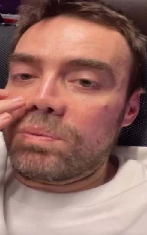 Murat Dalkılıç'ın Burun Ameliyatları: Son Gelişmeler ve Sağlık Durumu