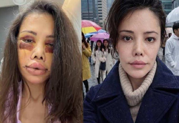 Yüz Nakli Sonrası Değişim ve Sosyal Medyada Gelen Yorumlar: Didem Ceran’ın Güncel Durumu