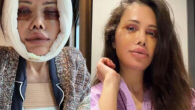 Split-screen of two women with facial injuries: left with a white head bandage and bruising around the eyes; right with swollen lips and long hair, wearing pink.