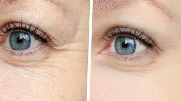 Close-up of a blue eye showing fewer wrinkles around the outer corner after treatment (before on left, after on right).