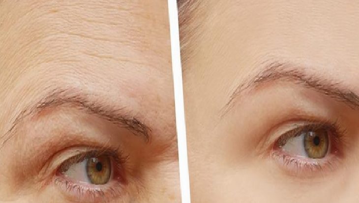 Before (left) and after (right) close-up of the eye area showing fewer wrinkles and smoother skin at the outer eye socket edge.