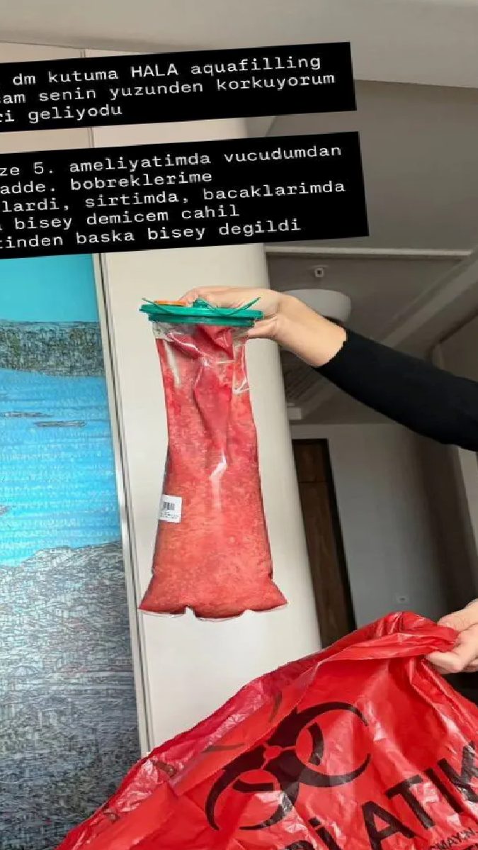 Aquafilling: Sağlık Riskleri ve Vücutta Kalıcı Etkiler Üzerine Bilgilendirici İnceleme