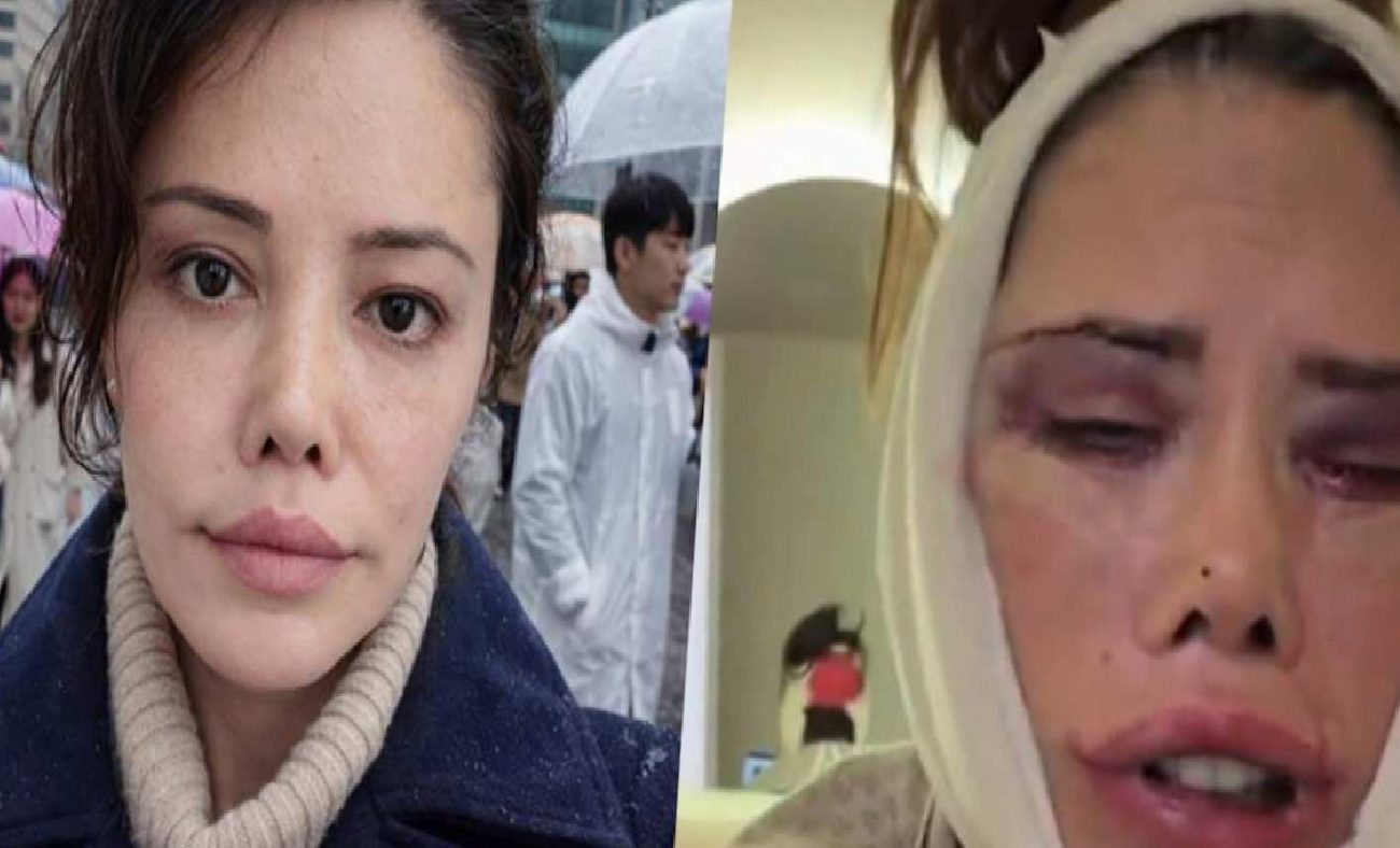 Didem Ceran: Yüz Revizyonu ve Tedavi Süreci Üzerine Güncel Gelişmeler