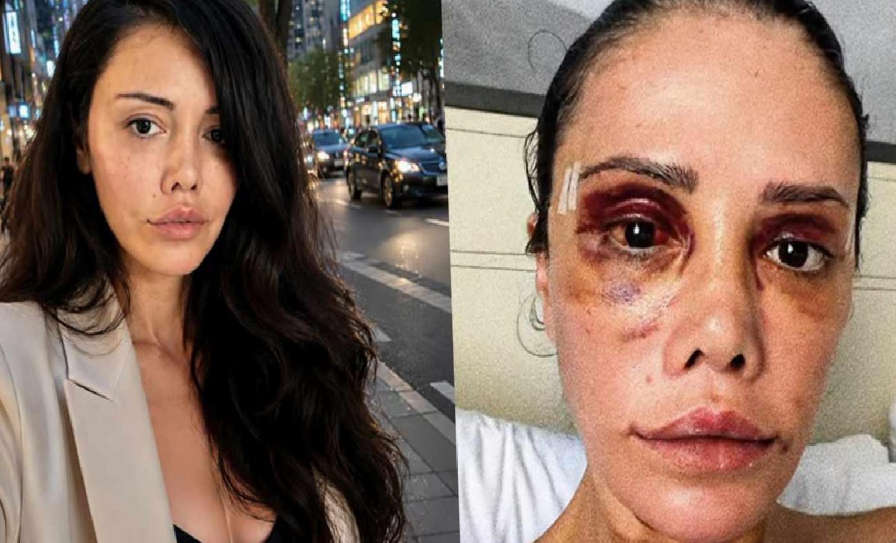 Didem Ceran'ın Kore'deki Yüz Nakli ve Revizyon Ameliyatı Sonrası Sağlık Durumu Açıklaması