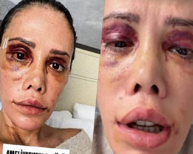 Didem Ceran'ın Kore'deki Yüz Nakli ve Revizyon Ameliyatı Sonrası Sağlık Durumu Açıklaması