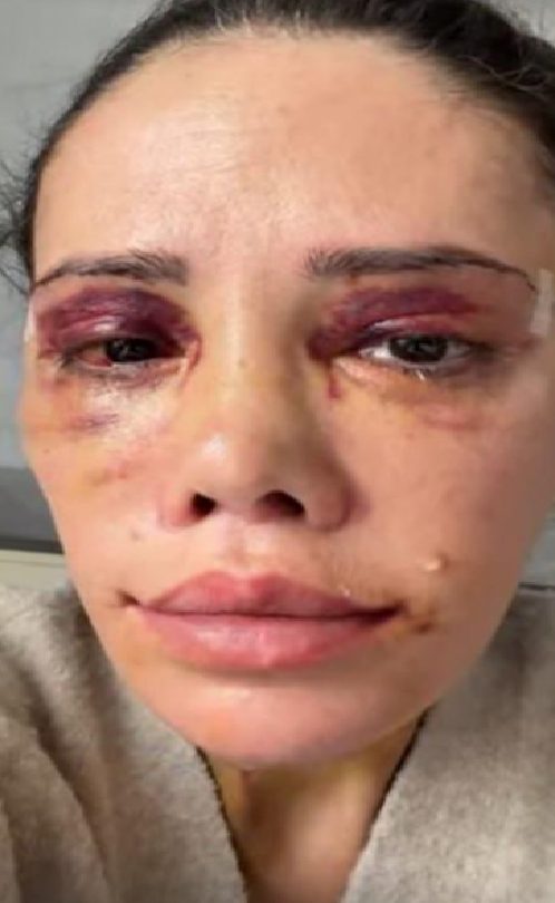 Didem Ceran'ın Kore'deki Yüz Nakli ve Revizyon Ameliyatı Sonrası Sağlık Durumu Açıklaması