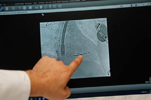 Mitral Kapak Mandallama ile Yaşamaya Dönüş: 70 Gün Yoğun Bakım Sonrası Yeniden Yürümenin Hikayesi