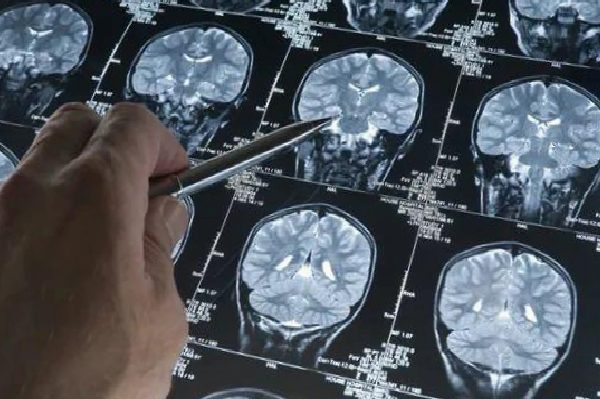 Havayolu Çalışanlarında Kansere Yol Açan Radyasyon Riski: 12 Milyon Kişinin İncelendiği Bulgular
