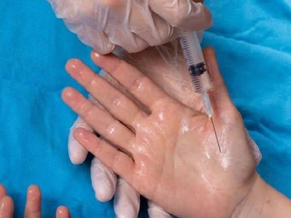 Koltukaltı ve Ellerde Terlemeyi 15 Dakikada Hafifleten Botoks Uygulaması: Yaz Aylarında Yaşam Kalitesini Artıran Güvenilir Yöntem