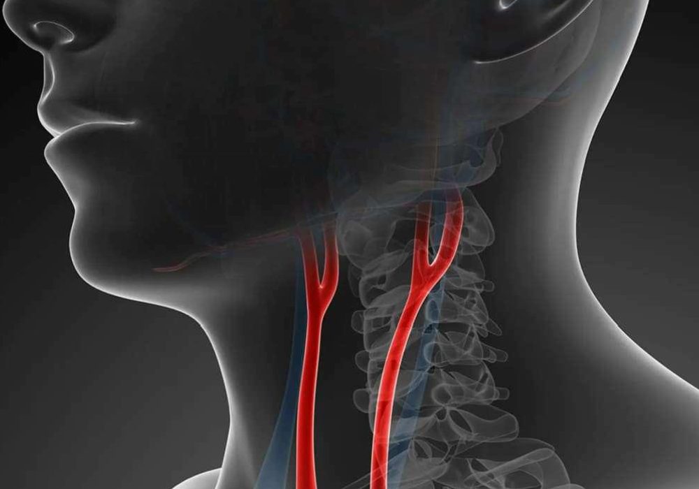 Şah Damarı Darlıkları: Belirti Vermeden Sessiz Tehlike ve Doppler ile Tespit